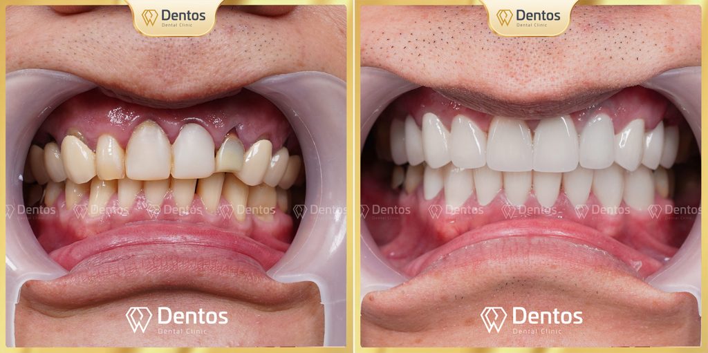 Làm răng sứ thẩm mỹ giá rẻ gây viêm nướu, viêm lợi, hôi miệng